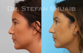 female patient before and after Rhinoplasty