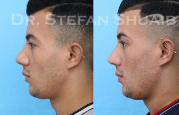 male patient before and after Rhinoplasty