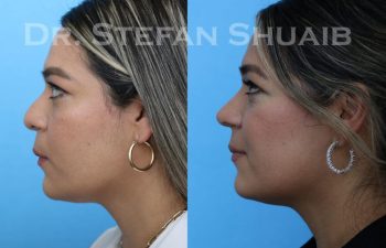 female patient before and after Rhinoplasty