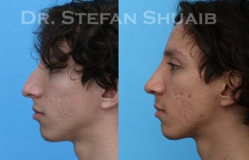 male patient before and after Rhinoplasty