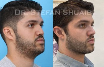 male patient before and after Rhinoplasty