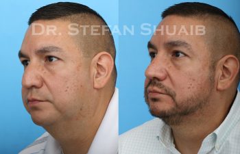 male patient before and after Rhinoplasty