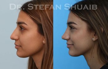 female patient before and after Rhinoplasty