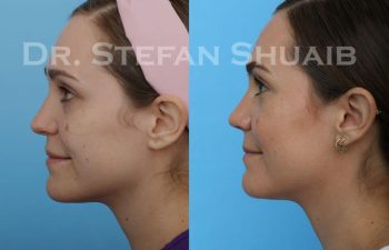 female patient before and after Rhinoplasty