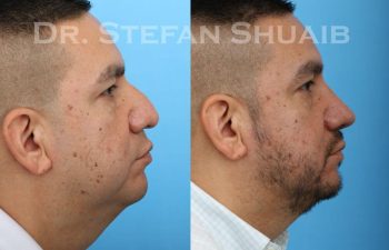 male patient before and after Rhinoplasty