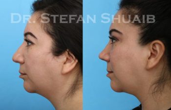 female patient before and after Rhinoplasty