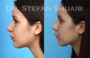 female patient before and after Rhinoplasty