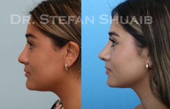 female patient before and after Rhinoplasty