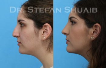 female patient before and after Rhinoplasty