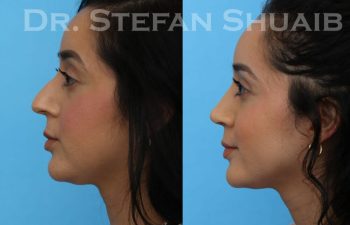 female patient before and after Rhinoplasty