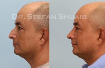 male patient before and after Rhinoplasty