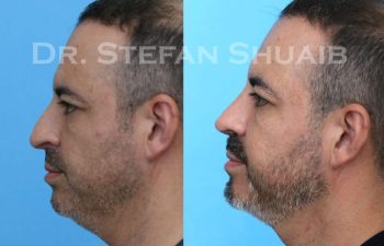 male patient before and after Rhinoplasty