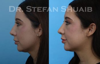 female patient before and after Rhinoplasty