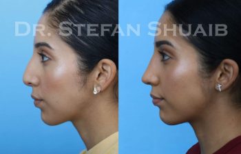 female patient before and after Rhinoplasty