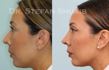 female patient before and after Rhinoplasty