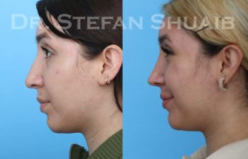 female patient before and after Rhinoplasty