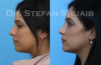 female patient before and after Rhinoplasty