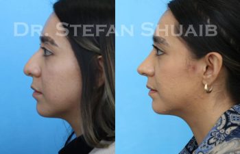 female patient before and after Rhinoplasty