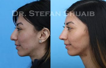 female patient before and after Rhinoplasty