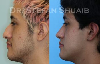 male patient before and after Rhinoplasty