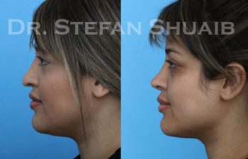 female patient before and after Rhinoplasty