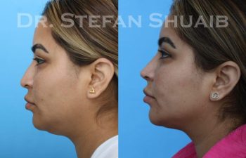 female patient before and after Rhinoplasty