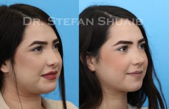 female patient before and after revision rhinoplasty