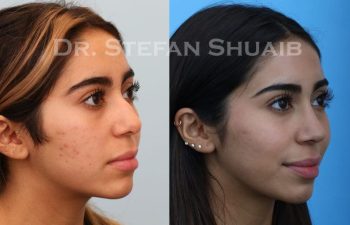 female patient before and after Rhinoplasty