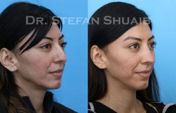 female patient before and after Rhinoplasty