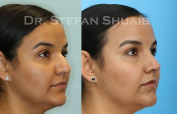 female patient before and after Rhinoplasty