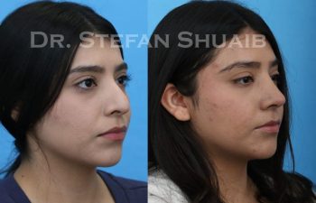 female patient before and after Rhinoplasty