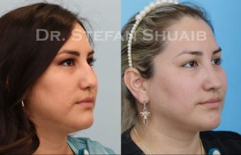 female patient before and after Rhinoplasty