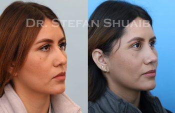 female patient before and after Rhinoplasty