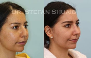 female patient before and after Rhinoplasty