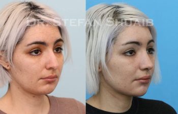 female patient before and after Rhinoplasty