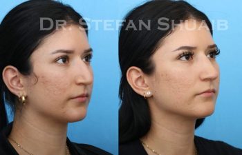 female patient before and after Rhinoplasty