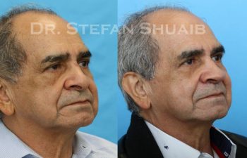 male patient before and after Rhinoplasty