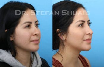 female patient before and after Rhinoplasty