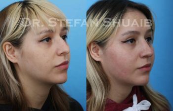 female patient before and after Rhinoplasty