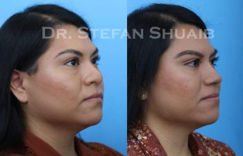 female patient before and after Rhinoplasty