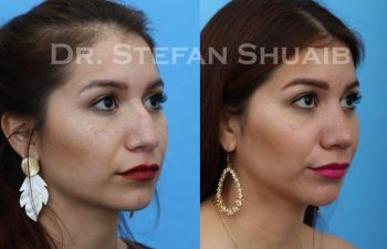 female patient before and after Rhinoplasty