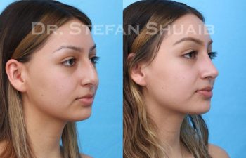 female patient before and after Rhinoplasty