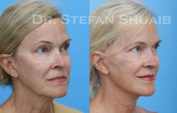 female patient before and after Facial Rejuvenation