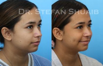 female patient before and after revision rhinoplasty