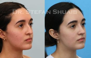 female patient before and after Rhinoplasty