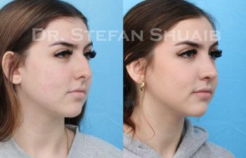 female patient before and after Rhinoplasty