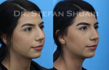 female patient before and after Rhinoplasty