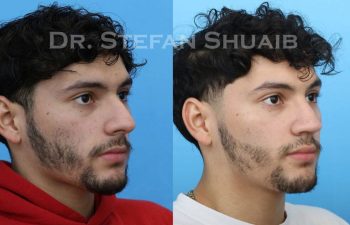 male patient before and after Rhinoplasty