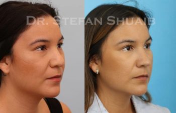 female patient before and after Rhinoplasty