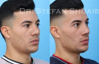 male patient before and after Rhinoplasty